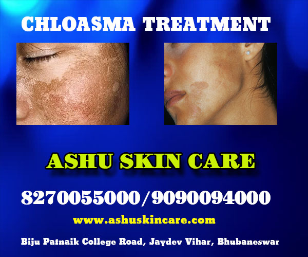 best chloasma treatment clinic  in bhubaneswar near capital hospital